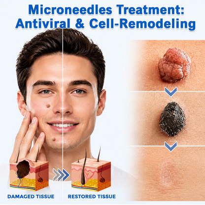 🔥GFOUK® 2-in-1 Microneedle & Hydrocolloid Patch🍀 | Removes raised moles, acne, flat warts, and skin tags | Helps improve wrinkles, scars, and blemishes | Invisible patches for face and body