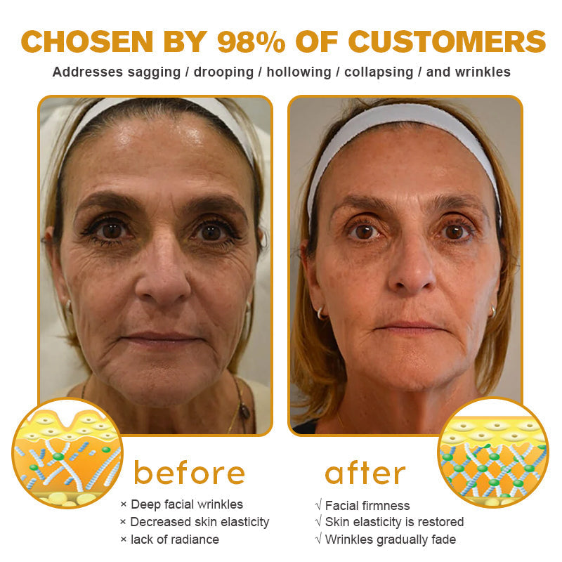 🐝✨ Made and Shipped from UK ✅ Furzero™ Botox Bee Venom Wrinkle Removal Cream - LAST DAY 70% OFF