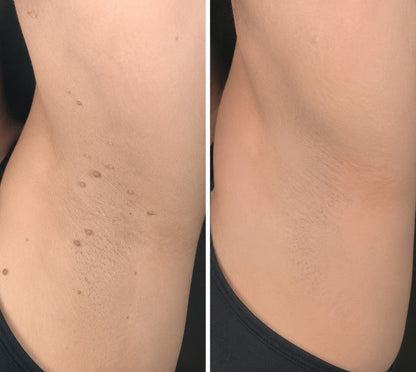 🔥GFOUK® 2-in-1 Microneedle & Hydrocolloid Patch🍀 | Removes raised moles, acne, flat warts, and skin tags | Helps improve wrinkles, scars, and blemishes | Invisible patches for face and body